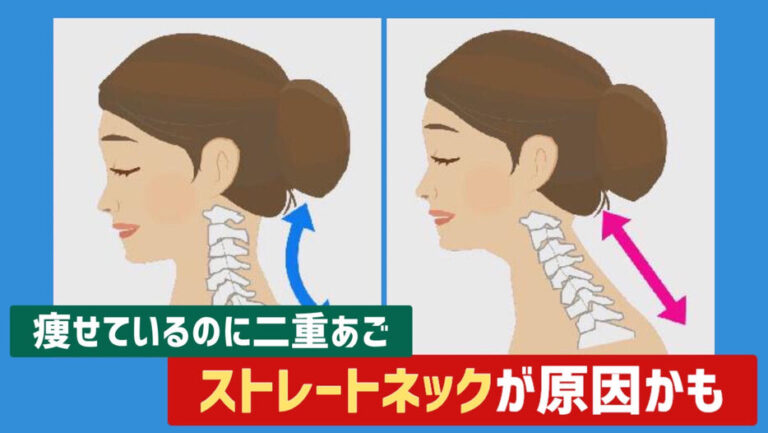 Hội chứng "Cổ thẳng" là gì? Nguyên nhân, triệu chứng và cách cải thiện đơn giản tại nhà
