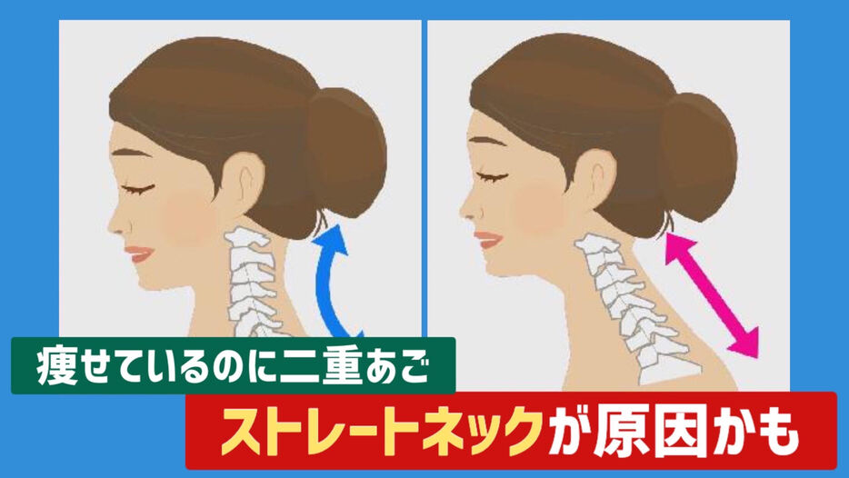 Hội chứng “Cổ thẳng” là gì? Nguyên nhân, triệu chứng và cách cải thiện đơn giản tại nhà