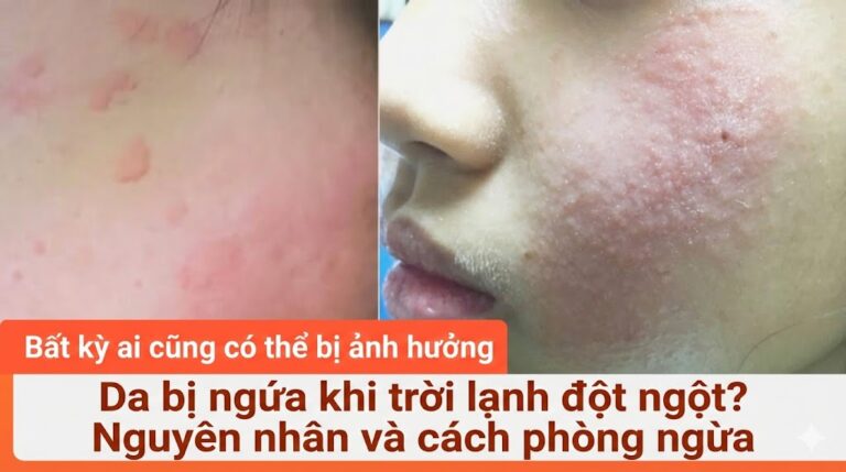 Da bị ngứa khi trời lạnh đột ngột? Nguyên nhân và cách phòng ngừa